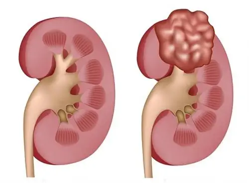 Рак почки и 10 способов снизить риск
