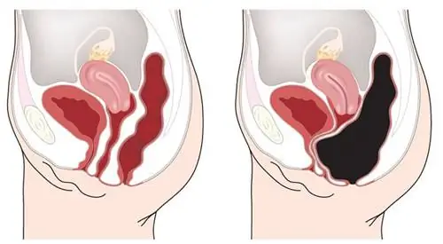 7 вещей, которые происходят в организме при задержке фекалий