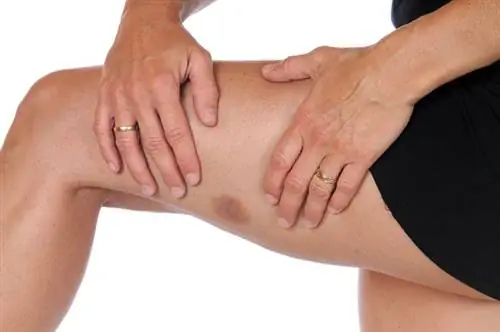 как убрать синяки