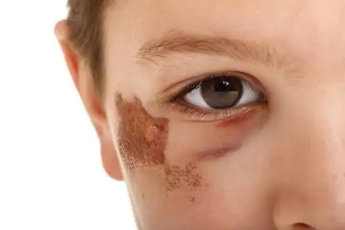 синяки и синяки