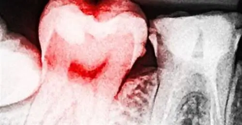 Признаки того, что у вас абсцесс зуба, и способы его естественного лечения