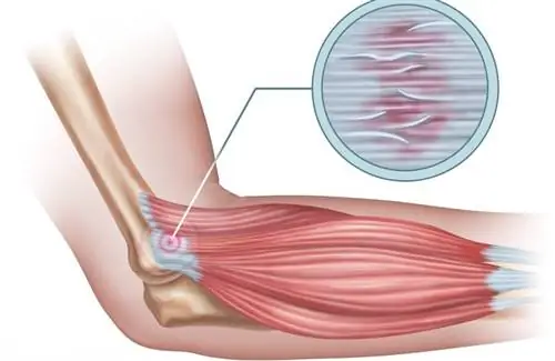теннисный локоть