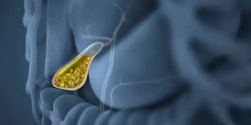 Диета для желчного пузыря и естественный протокол лечения