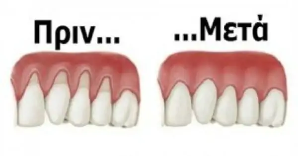 Восстановление ваших десен до их первоначального состояния с помощью натуральных рецептов