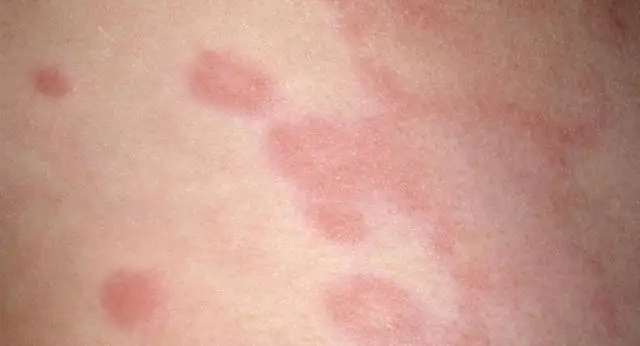 От чего у тыкв появляются бородавки?